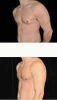 Doctor Brian Vassar Heil, MD, Pittsburgh Plastic Surgeon - Male Breast Reduction