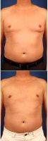 Doctor Carlos Mata, MD, MBA, FACS, Scottsdale Plastic Surgeon 45-54 Year Old Man Treated With Male Breast Reduction