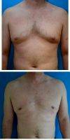 Doctor Charles Galanis, MD, Beverly Hills Plastic Surgeon 44 Year Old Man Treated With Male Breast Reduction