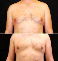 Doctor Chia Jen Lynn Chung, MD, Puyallup Plastic Surgeon 35 Year Old Male Treated With Male Breast Reduction
