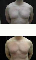 Doctor Christopher J. Davidson, MD, FACS, Boston Plastic Surgeon - Male Breast Reduction