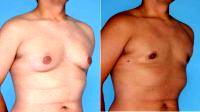 Doctor Dan Mills, MD, Orange County Plastic Surgeon 24 Year Old Male Treated For Gynecomastia With Liposuction