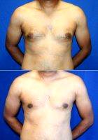 Doctor Daniel Brown, MD, FACS, La Jolla Plastic Surgeon 36 Year Old Man Treated With Male Breast Reduction