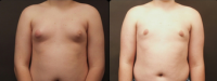 Doctor David A. Ross, MD (retired), Chicago Plastic Surgeon Male Breast Reduction Liposuction