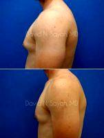 Doctor David N. Sayah, MD, FACS, Beverly Hills Plastic Surgeon Male Breast Reduction