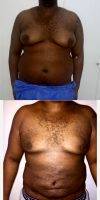 Doctor Derby Sang Caputo, MD, Dominican Republic Plastic Surgeon 34 Year Old Man Treated With Male Breast Reduction
