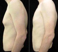 Doctor Don W. Griffin, MD, Nashville Plastic Surgeon 21 Year Old Man Treated With Male Breast Reduction For Gynecomastia