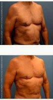 Doctor Douglas Hendricks, MD, Newport Beach Plastic Surgeon Male Breast Reduction