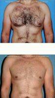 Doctor Douglas Hendricks, MD, Newport Beach Plastic Surgeon Male Breast Reduction