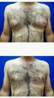 Doctor Douglas M. Senderoff, MD, FACS, New York Plastic Surgeon 35-44 Year Old Man Treated With Male Breast Reduction