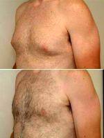 Doctor Franklin D. Richards, MD, Bethesda Plastic Surgeon 29 Year Old Male With Enlarged Breasts (gynecomastia)