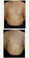 Doctor George Bitar, MD, Fairfax Plastic Surgeon 25-34 Year Old Man Treated With Male Breast Reduction