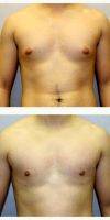 Doctor Glenn Lyle, MD, Raleigh-Durham Plastic Surgeon 24 Year Old Man Treated With Male Breast Reduction