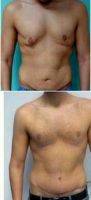 Doctor Guray Yesiladali, MD, Turkey Plastic Surgeon 25-34 Year Old Man Treated With Male Breast Reduction