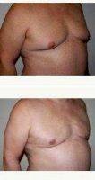 Doctor Hayley Brown, MD, FACS, Las Vegas Plastic Surgeon Man Treated With Male Breast Reduction