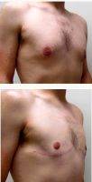 Doctor J. Jason Wendel, MD, FACS, Nashville Plastic Surgeon Male Breast Reduction For This 25 Year Old Man