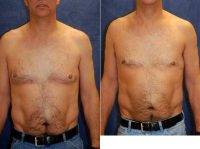 Doctor James A. Hoffman, MD, Saint Paul Plastic Surgeon Male Breast Reduction - Gynecomastia