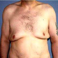 Doctor James Murphy, FRCS(Plast), Manchester Plastic Surgeon Male Breast Reduction