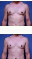 Doctor Jeffrey K. Scott, MD, Sarasota Plastic Surgeon Male Breast Reduction (Gynecomastia)
