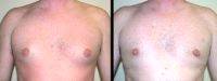 Doctor Jerome Edelstein, MD, Toronto Plastic Surgeon Male Breast Reduction With Liposuction