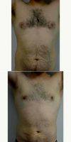Doctor Jonathan Hall, MD, Boston Plastic Surgeon 31 Year Old Man Treated With Male Breast Reduction