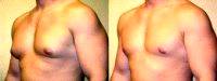 Doctor Kenneth Dembny, II, MD, Milwaukee Plastic Surgeon Male Breast Reduction - Excision & Liposuction Before (1)