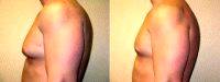 Doctor Kenneth Dembny, II, MD, Milwaukee Plastic Surgeon Male Breast Reduction - Excision & Liposuction Before (2)
