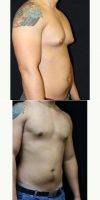 Doctor Kris M. Reddy, MD, FACS, West Palm Beach Plastic Surgeon 22 Year Old Man Treated With Male Breast Reduction