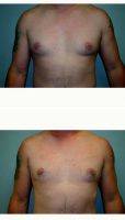 Doctor Leo Lapuerta, MD, Houston Plastic Surgeon 35-44 Year Old Man Treated With Male Breast Reduction