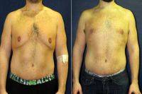 Doctor Matthew Schulman, MD, New York Plastic Surgeon Male Chest Reduction And Liposuction