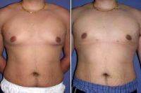 Doctor Max Polo, MD, Miami Plastic Surgeon Male Breast Reduction Gynecomastia