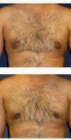 Doctor Michael Eisemann, MD, Houston Plastic Surgeon 30 Year Old Man Treated With Subcutaneous Mastectomy Male Breast Reduction