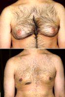 Doctor Miguel Delgado, MD, San Francisco Plastic Surgeon Male Breast Reduction