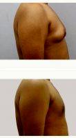 Doctor Milan Doshi, MS, MCh, India Plastic Surgeon 25-34 Year Old Man Treated With Male Breast Reduction (Gynecomastia)