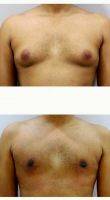 Doctor Milan Doshi, MS, MCh, India Plastic Surgeon 27 Year Old Man Treated With Male Breast Reduction