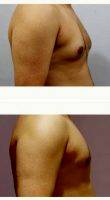 Doctor Milan Doshi, MS, MCh, India Plastic Surgeon 28 Year Old Man Treated With Male Breast Reduction