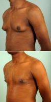 Doctor Morgan E. Norris, III, MD, FACS, Houston Plastic Surgeon 18-24 Year Old Man Treated With Male Breast Reduction