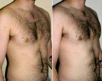 Doctor Otto Joseph Placik, MD, Chicago Plastic Surgeon Male Breast Reduction