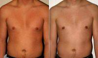 Doctor Otto Joseph Placik, MD, Chicago Plastic Surgeon Male Breast Reduction Results (1)