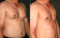 Doctor Otto Joseph Placik, MD, Chicago Plastic Surgeon Male Breast Reduction Results (2)