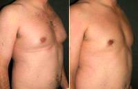 Doctor Otto Joseph Placik, MD, Chicago Plastic Surgeon Male Breast Reduction Results (3)