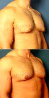 Doctor Patrick W. Hsu, MD, FACS, Houston Plastic Surgeon Man Treated With Male Breast Reduction