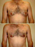 Doctor Richard A. Bartlett, MD, Brookline Plastic Surgeon Gynecomastia. Correction With Liposuction And Resection Of Gland. Incision Around Nipple