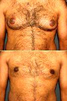 Doctor Richard L. Dolsky, MD (retired), Philadelphia Plastic Surgeon Male Breast Reduction (Gynecomastia)