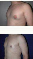 Doctor Richard Zienowicz, MD, Providence Plastic Surgeon 25-34 Year Old Man Treated With Male Breast Reduction