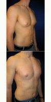 Doctor Richard Zienowicz, MD, Providence Plastic Surgeon 35-44 Year Old Man Treated With Male Breast Reduction