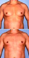 Doctor Rikesh T. Parikh, MD, Bellevue Plastic Surgeon Male Breast Reduction Gynecomastia