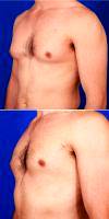 Doctor Robert Caridi, MD, Austin Plastic Surgeon 24 Year Old Man Treated With Gynecomastia Removal Treatment - Male Breast Reduction