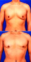 Doctor Robert Caridi, MD, Austin Plastic Surgeon 35-44 Year Old Man Treated With Gynecomastia - Male Breast Reduction