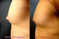 Doctor Ronald Friedman, MD, Plano Plastic Surgeon - Male Nipple Reduction Before And After (1)